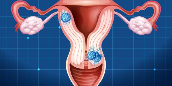 Ankara Myom Ameliyatı ve Tedavisi - Op. Dr. Fatma Aslıhan Kara.