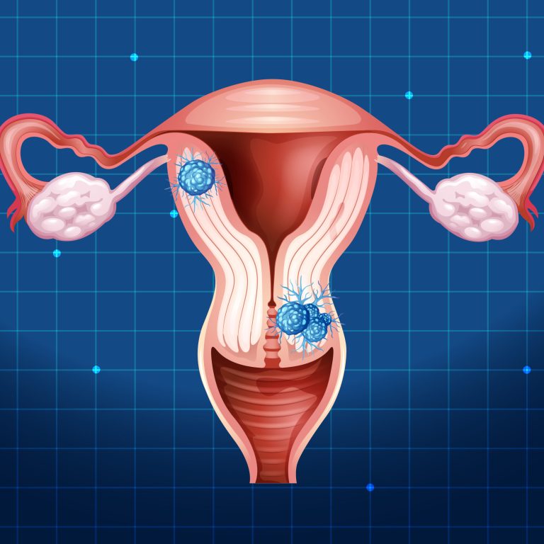 Ankara Myom Ameliyatı ve Tedavisi - Op. Dr. Fatma Aslıhan Kara.