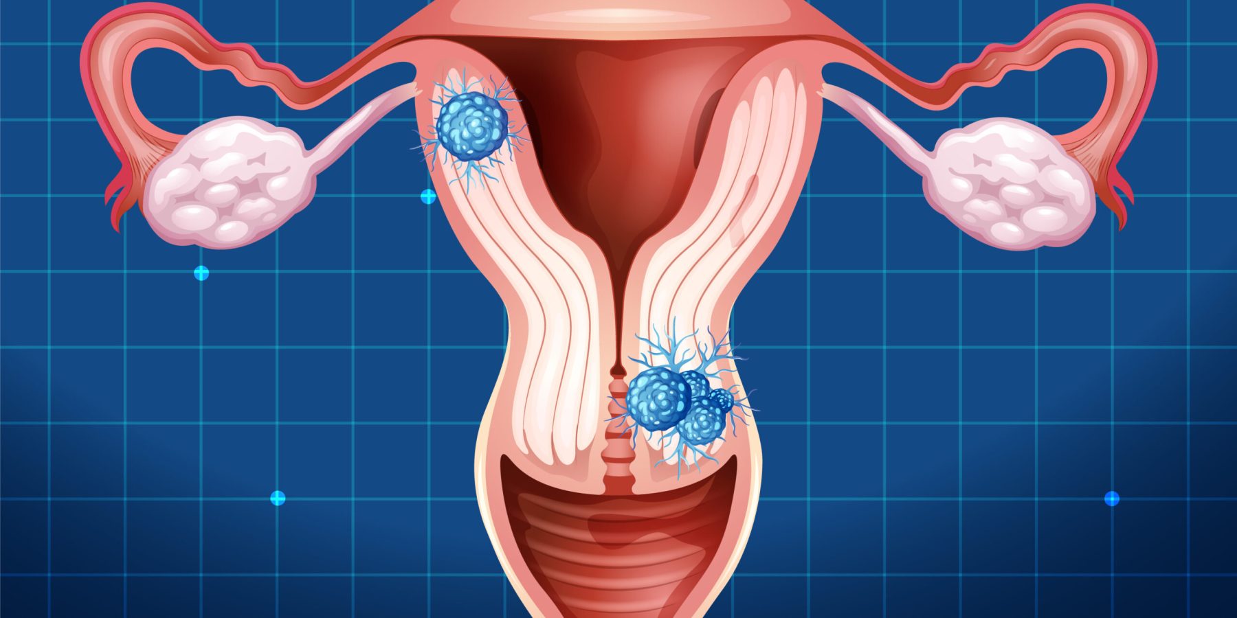 Ankara Myom Ameliyatı ve Tedavisi - Op. Dr. Fatma Aslıhan Kara.
